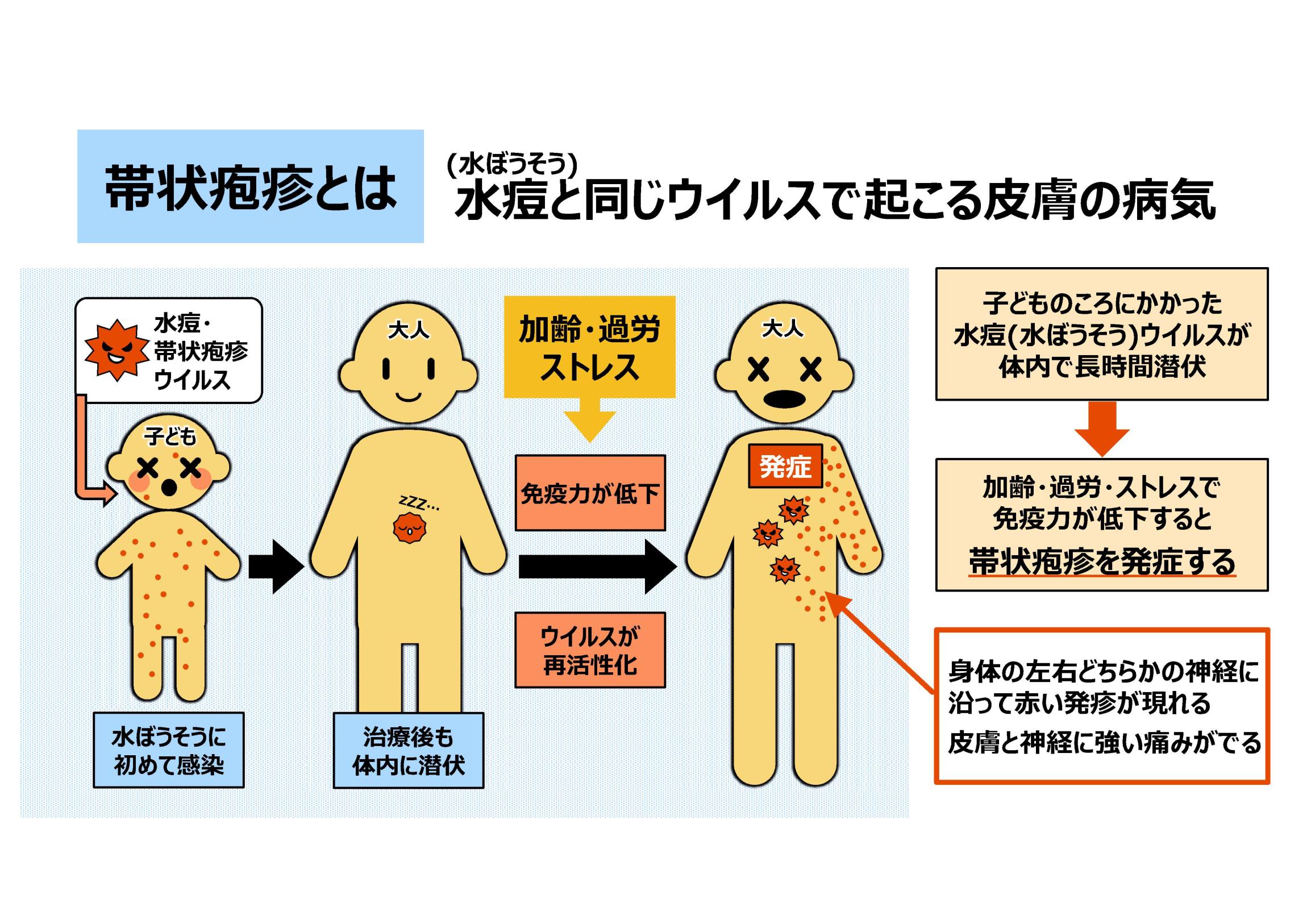 帯状疱疹スライド（帯状疱疹とは）